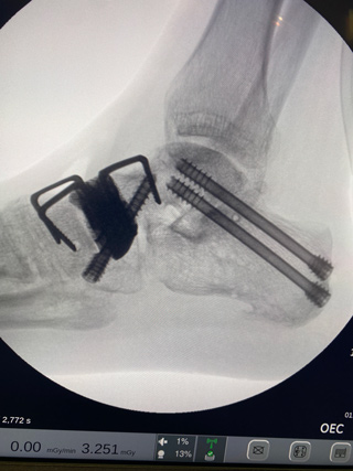 Ankle Fractures img