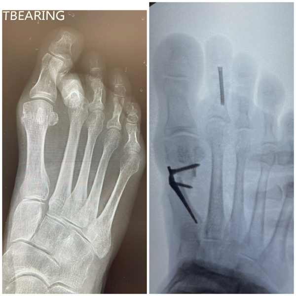 Toe Fractures img2